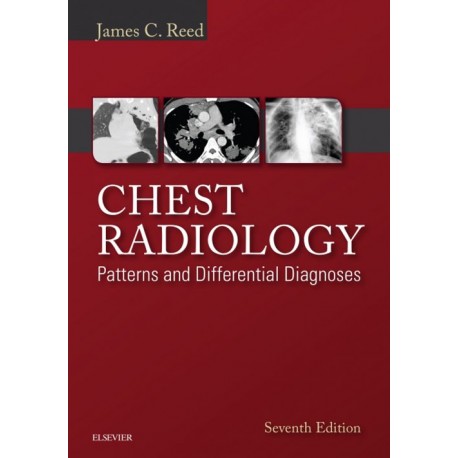 Chest Radiology: Patterns and Differential Diagnoses E-Book (ebook) - Envío Gratuito